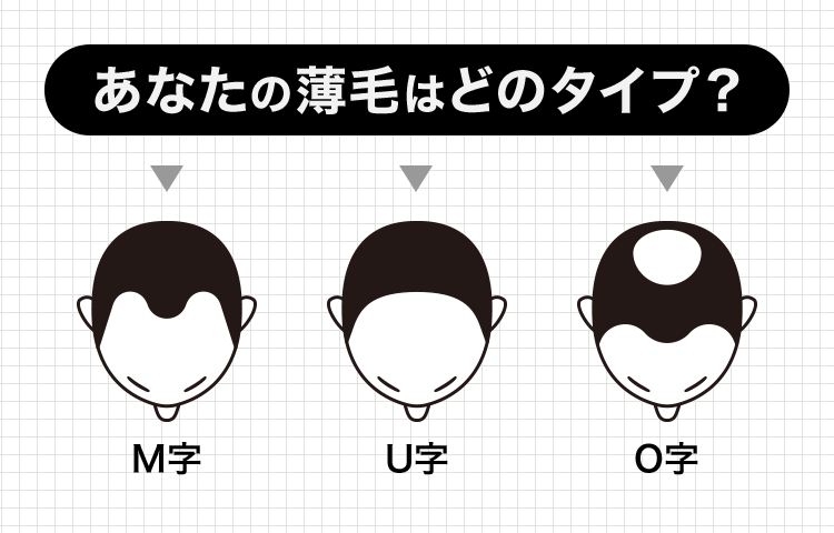 あなたの薄毛はどのタイプ?